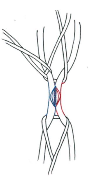 Comunicaciones arterio-venosas - BlogMedicina: Aprende como Dibujar y Colorear Fácil, dibujos de Venas, como dibujar Venas paso a paso para colorear